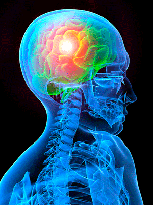 graphic of inflamed brain